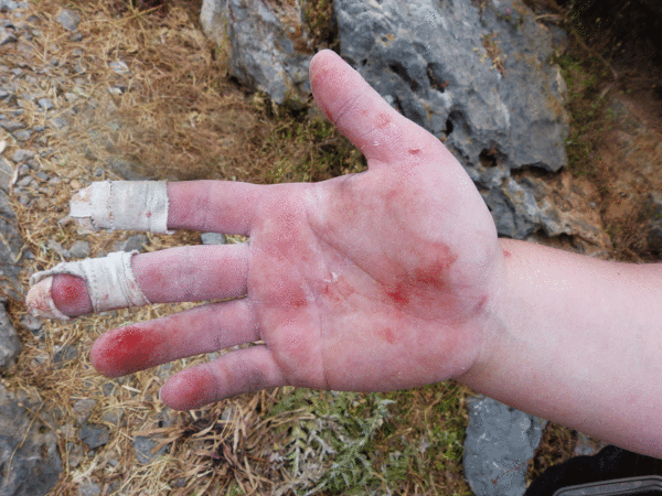 Verletzungen beim Klettern